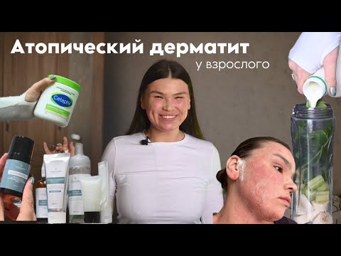 Видео: Атопический дерматит у взрослого/Синдром отмены гормональной мази/ Как помочь?