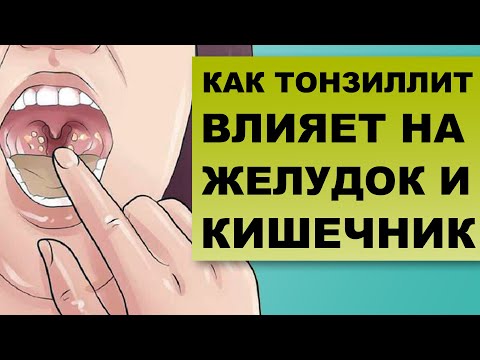 Видео: ТОНЗИЛЛИТ и ЖЕЛУДОЧНО-КИШЕЧНЫЙ ТРАКТ