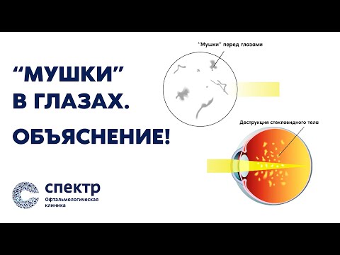 Видео: "Мушки в глазах". ОБЪЯСНЕНИЕ! Реально ли избавиться? Отвечает профессор, врач-офтальмолог Кожухов.