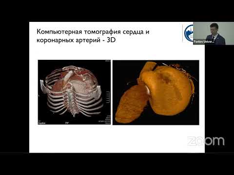 Видео: Возможности методов визуализации в диагностике и определении тактики лечения атриомегалии