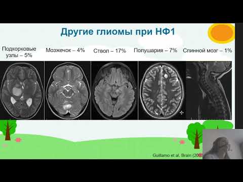 Видео: Лечение глиом зрительного пути у детей с нейрофиброматозом. Спикер: Эндже Фаварисовна Валиахметова