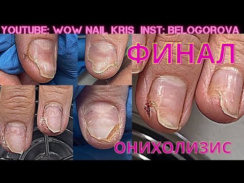 Видео: Пришла без ногтей совсем😱| Мы победили этот СТРАШНЫЙ ОНИХОЛИЗИС | Часть 3 | Финал