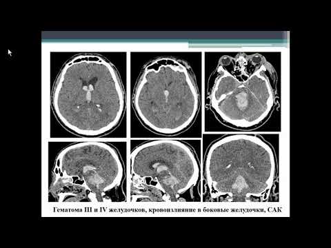 Видео: Ипатов В.В.«КТ в неотложной диагностике горнолыжной травмы»