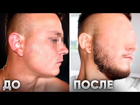 Видео: Мазал это средство и ОТРАСТИЛ БОРОДУ С НУЛЯ. Результат XILNOXIN