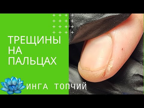 Видео: Трещины на пальцах. Лечение пальцев рук #4