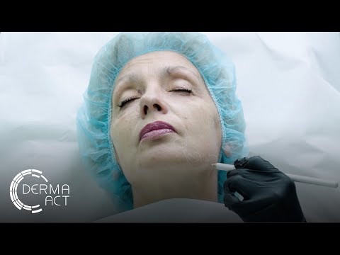 Видео: Поставяне на филъри за цяло лице