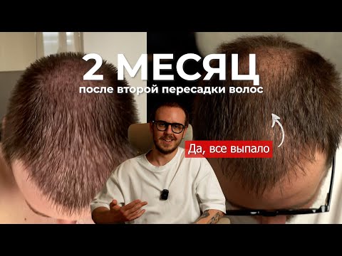 Видео: 2 МЕСЯЦ после ПЕРЕСАДКИ ВОЛОС (второй)