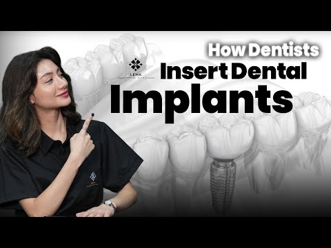 Видео: 🤍 Как стоматологи устанавливают зубные имплантаты? Больно ли это? — Стоматологическая клиника Lema