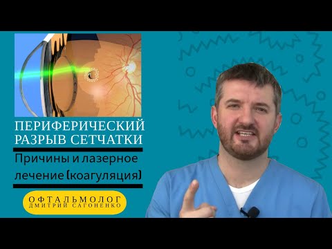 Видео: Периферический разрыв сетчатки - причины и лазерное лечение (коагуляция) 👀💥