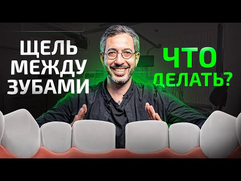 Видео: Диастема. Почему возникает щель между зубами, как убрать и можно ли оставить?