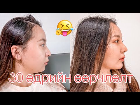 Видео: 30өдрийн дараа 💉✨ (асуулт &хариулт)  My plastic surgery in korea pt4