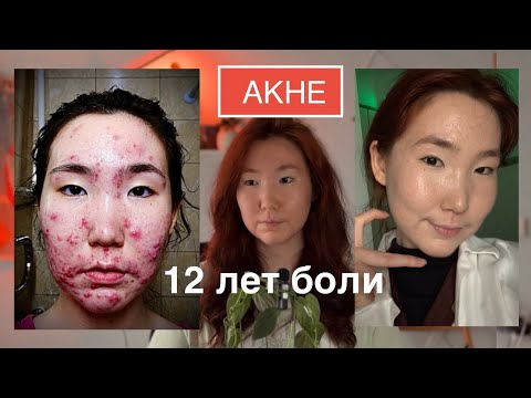 Видео: Моя история акне: 12 лет боли