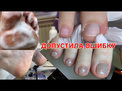 Видео: Педикюр 🦶ПОДНОГТЕВЫЕ МОЗОЛИ 🙈/ Возвращаем стопы 🦶 к жизни .