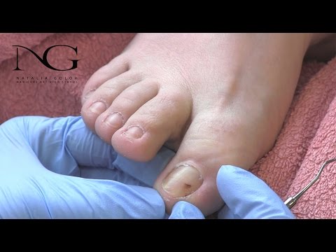 Видео: Коррекция вросшего ногтя | Педикюр | Correction of ingrown nail and tamponade.