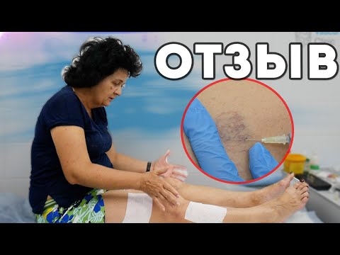Видео: ОТЗЫВ ПАЦИЕНТА после СКЛЕРОТЕРАПИИ
