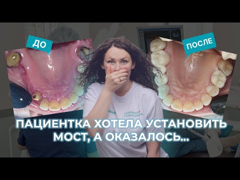 Видео: Нечем жевать? Что делать если НЕТ ЗУБОВ? Смотри ДО и ПОСЛЕ нашего пациента