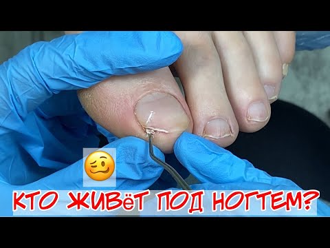 Видео: Как убрать подногтевую мозоль на ноге 😱 Почему болят ногти на ногах? 🥴