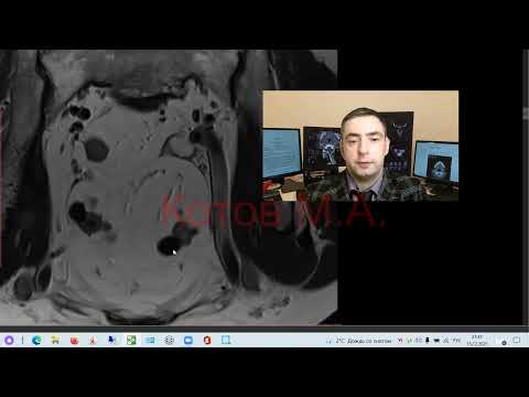 Видео: Дивертикулез тонкой кишки на МРТ. Ролик №14.
