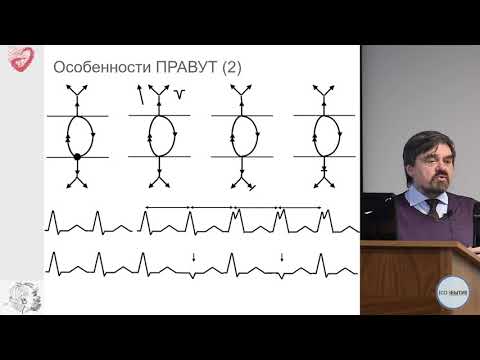 Видео: Дифференциальная диагностика регулярных тахикардий