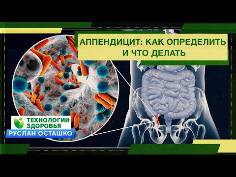 Видео: Аппендицит: как определить и что делать (Руслан Осташко)
