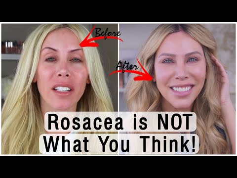 Видео: 3 шага к полному выздоровлению от розацеа в домашних условиях! Врач не нужен!
