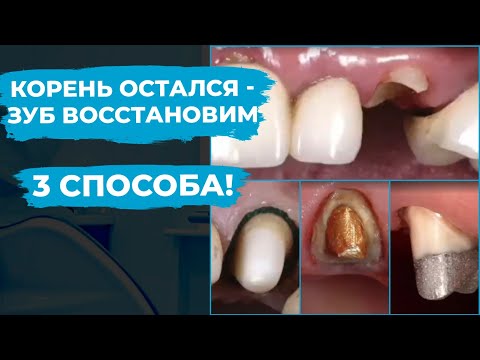 Видео: Остался корень зуба. 3 метода восстановления!