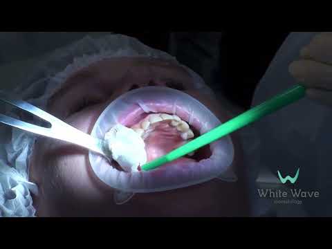 Видео: Можно ли ставить имплант сразу после удаления зуба? Одномоментная имплантация за 9 минут