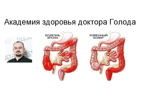 Видео: Неспецифический язвенный колит и болезнь Крона.