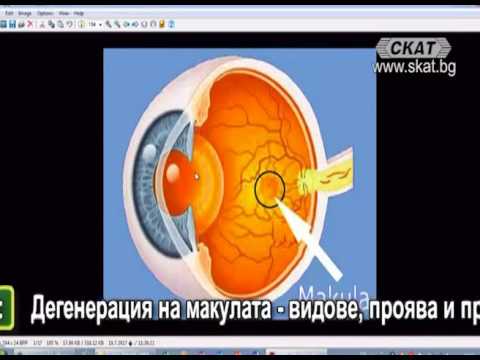 Видео: Академия Здравословно: Дегенерация на макулата - видове, проява и прогноза