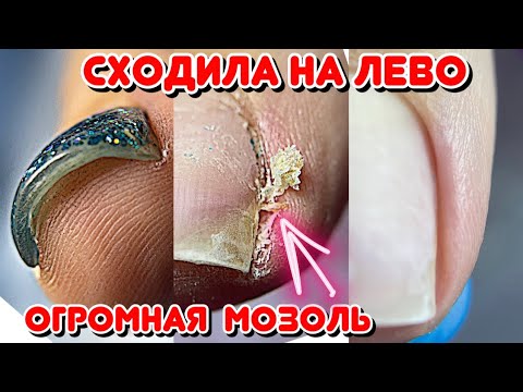 Видео: Как убрать подногтевую мозоль 😱 Ногти плюшки 💅 Педикюр