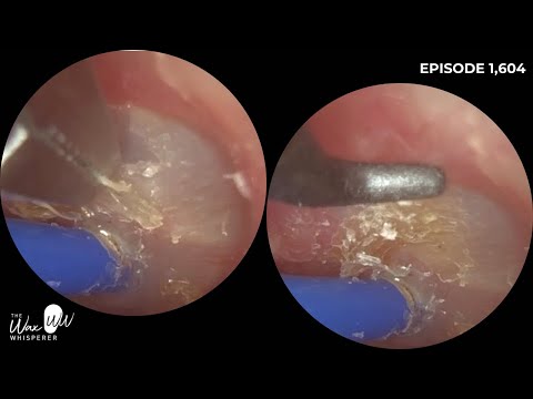 Видео: 1,604 - Сборник деликатного отслоения омертвевшей кожи с барабанной перепонки с использованием уш...