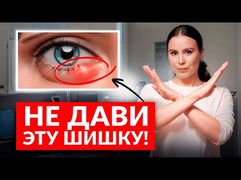 Видео: Шишка на веке: ячмень или халязион? Как отличить и что делать