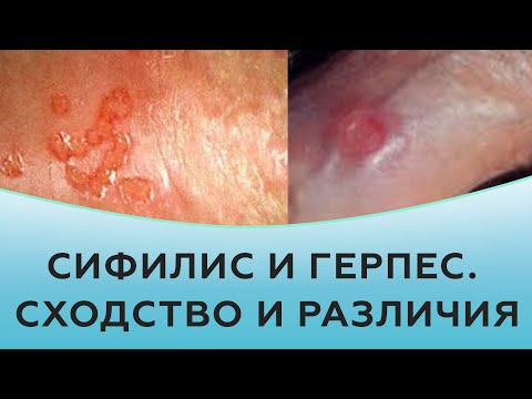 Видео: Сифилис и герпес. Сходство и различия