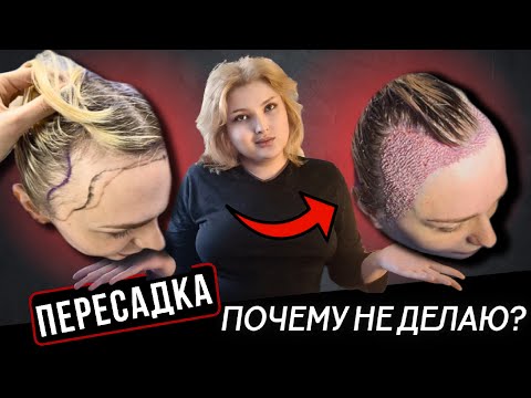 Видео: Андрогенная алопеция у женщин | Почему я НЕ делаю пересадку волос?