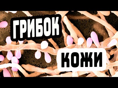 Видео: КАК ИЗБАВИТЬСЯ ОТ ГРИБКА НА КОЖЕ / ЛЕЧЕНИЕ ГРИБКА НА КОЖЕ / ГРИБОК КОЖИ
