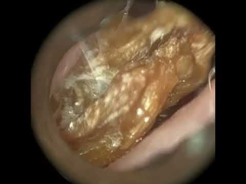 Видео: 253 - Комплексное удаление ушной серы и омертвевшей кожи из узкого уха с помощью WAXscope®️