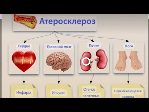Видео: Атеросклероз. Этиологисы. Патогенезі