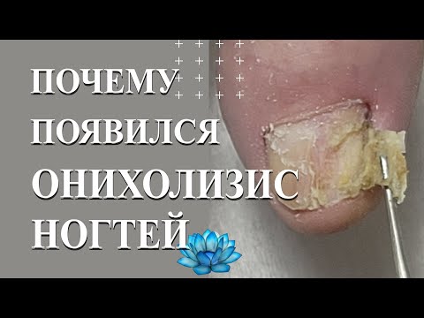 Видео: Как делать аппаратный педикюр когда у клиента онихолизис ногтей.