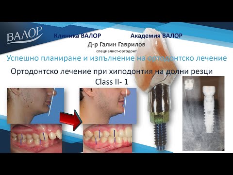 Видео: Ортодонтско-протетично лечение на II-1 клас и хиподонтия с имплант в долна челюст.