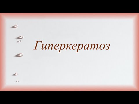 Видео: Гиперкератоз.