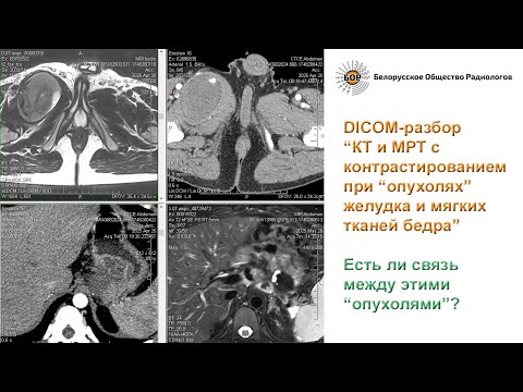 Видео: КТ и МРТ с контрастированием при «опухолях» желудка и мягких тканей бедра