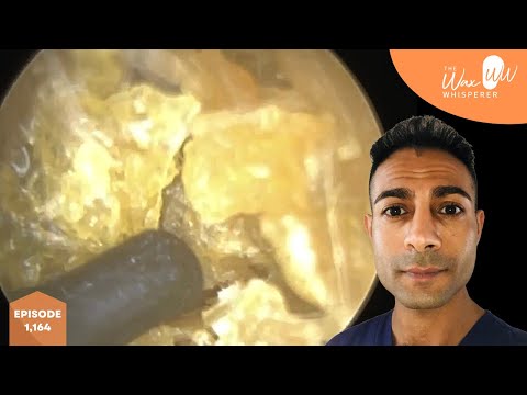 Видео: 1,164 - Полное удаление омертвевшей кожи из уха ребенка