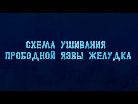 Видео: Схема ушивания прободной язвы желудка