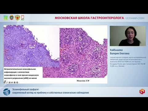 Видео: Кайбышева В.О. Эозинофильный эзофагит: современный взгляд на проблему и собственные клинические набл