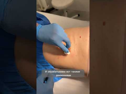 Видео: Обработка раны после хирургического удаления родинки. Онколог Джунковская Н.В.,  www.nevus.pro