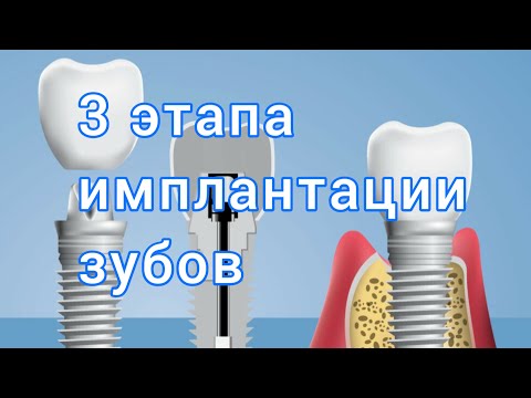 Видео: Что входит в ИМПЛАНТАЦИЮ зуба? ЭТАПЫ имплантации зубов.