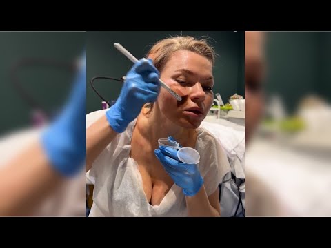 Видео: Лечение Розацеа, процедуры себе. Дерматоонколог Перевалова Елена Геннадьевна. Эфир 1 апреля 2025