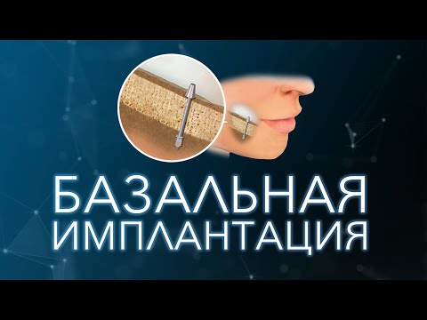 Видео: Базальная имплантация зубов.