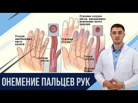 Видео: Онемение пальцев рук. Причина. Решение.