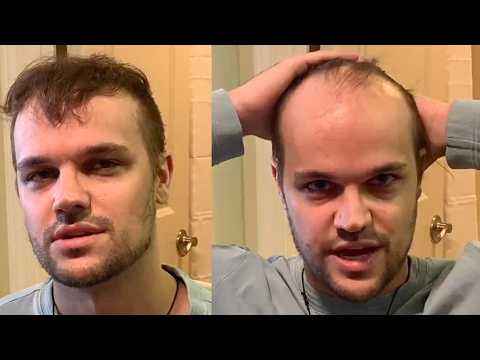 Видео: ЛЫСЕНИЕ Братья-близнецы впервые побрили головы налысо